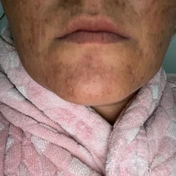 Nicarich Arc Sistem İşlem Sonrası Cildimde Ciddi Yanıklar, Yaralar Ve İzler Oluştu