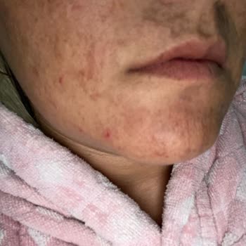 Nicarich Arc Sistem İşlem Sonrası Cildimde Ciddi Yanıklar, Yaralar Ve İzler Oluştu