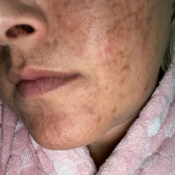 Nicarich Arc Sistem İşlem Sonrası Cildimde Ciddi Yanıklar, Yaralar Ve İzler Oluştu