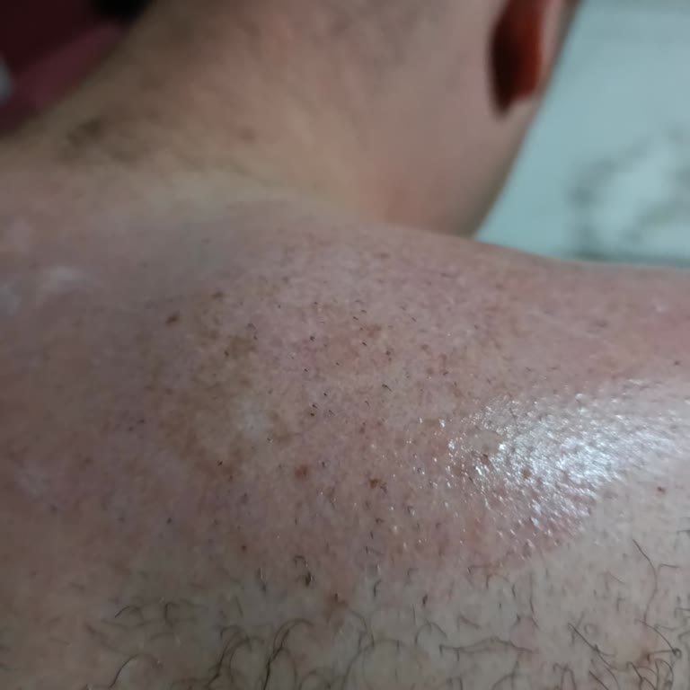 Tüy Dökücü Krem Ciddi Cilt Yanığına Ve Kanamaya Neden Oldu