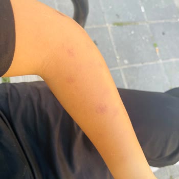 Lazer Epilasyon Sonrası Kollarımda Yanıklar Oluştu, Ücret İadesi İstiyorum