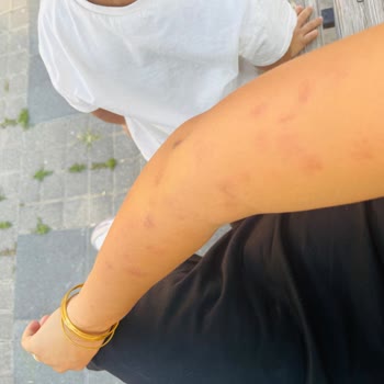 Lazer Epilasyon Sonrası Kollarımda Yanıklar Oluştu, Ücret İadesi İstiyorum