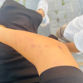 Lazer Epilasyon Sonrası Kollarımda Yanıklar Oluştu, Ücret İadesi İstiyorum