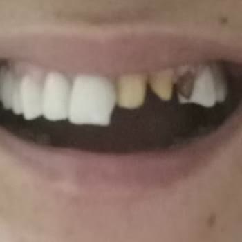 Zirkonyum Kaplama Kırıldı, Klinik Sorumluluk Almadı Ve Çözüm Sunmadı