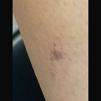 Lazer Epilasyon Sonrası Yanıklar Ve Yetersiz Müşteri Desteği