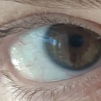 Tedaviye Rağmen İyileşmedim, Kontrol İçin Tekrar Ücret Talep Edildi