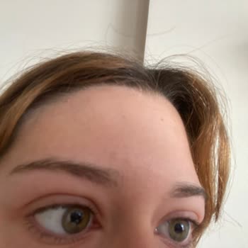 Watsons Micellar Temizleme Suyu Cildimde Şiddetli Alerjik Reaksiyona Sebep Oldu, Müşteri Hizmetleri İlgisiz Kaldı