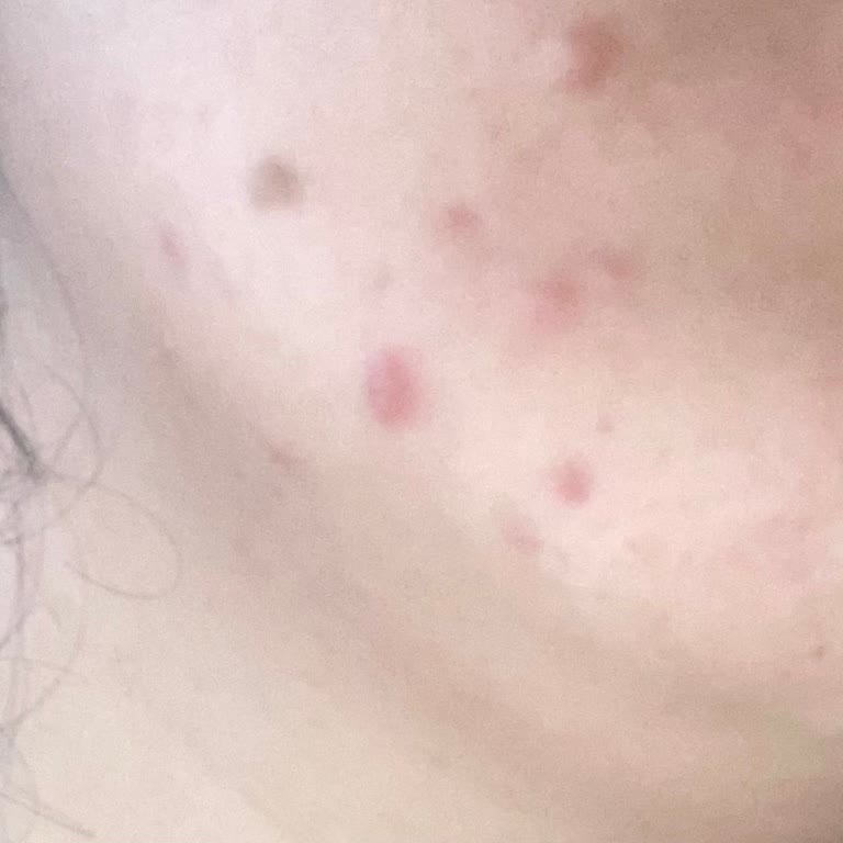 Zade Vital Marine Kolajen Sonrası Çenemde İltihaplı Sivilce Oluştu