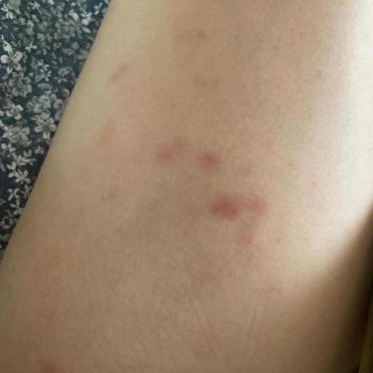 Bölgesel İncelme Sonrası Morluk, Ağrı Ve Tehdit İle Ücret Talebi Mağduriyeti