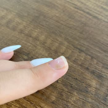 Kapsül Protez Tırnak Sonrası Sağlığım Tehlikeye Girdi