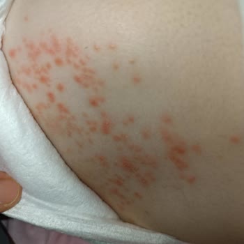 Molfix Bebek Bezi Alerji Yaptı, Müşteri Hizmetlerinden Dönüş Alamadım