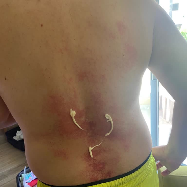 Tüy Dökücü Ürün Ciddi Yanık Ve Sağlık Sorunlarına Yol Açtı