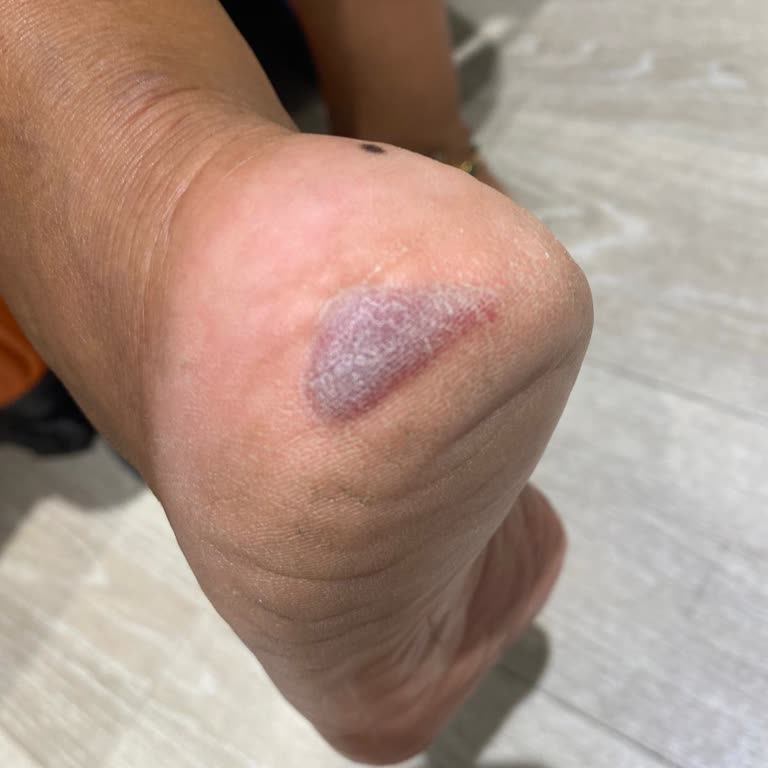 Kısa Sürede Ciddi Sağlık Sorunu Yaratan Ayakkabıya İade Reddi