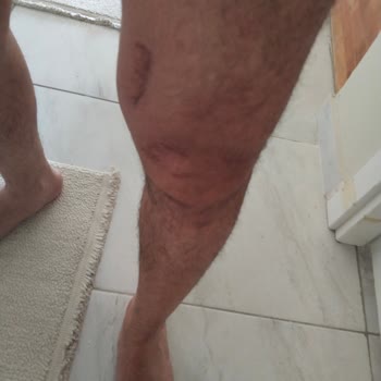 Doğa Sigorta, 2,5 Yıldır Bedeni Hasar Ödememi Yapmıyor Ve Mağduriyetimi Artırıyor