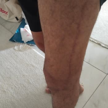 Doğa Sigorta, 2,5 Yıldır Bedeni Hasar Ödememi Yapmıyor Ve Mağduriyetimi Artırıyor