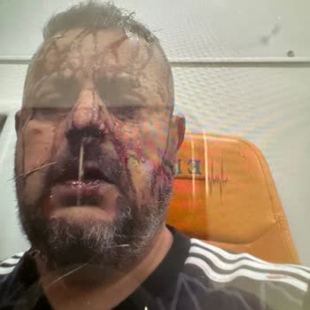 Corpus Sigorta Kazadan Sonra Tazminatım 2 Yıldır Ödenmiyor, Mağduriyetim Artıyor