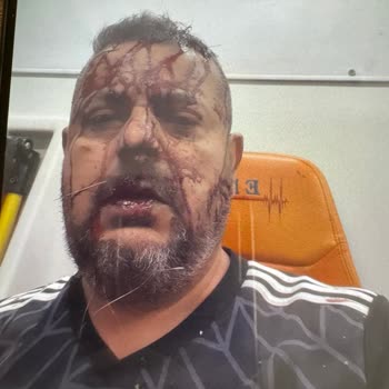 Corpus Sigorta Kazadan Sonra Tazminatım 2 Yıldır Ödenmiyor, Mağduriyetim Artıyor