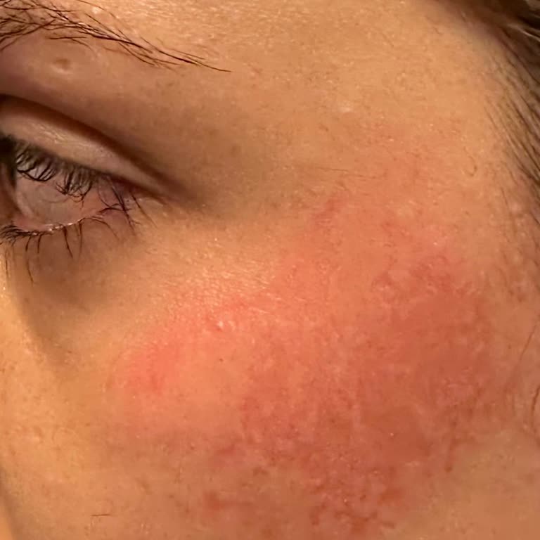 Yüzde Kabarma Ve Şişlik Sonrası İlgisiz Yaklaşım Mağduriyet Yarattı