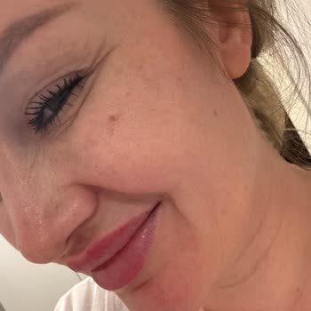 Liva Clinic’te Etkisiz Botox Ve Dolgu Sonrası Hayal Kırıklığı