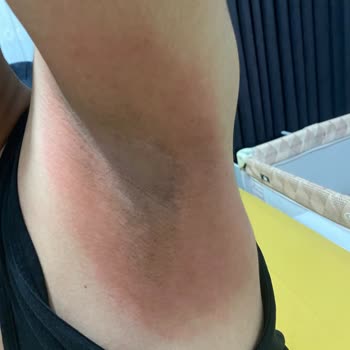 Nivea Men Soft Deodorant Koltuk Altımda Alerji Yaptı