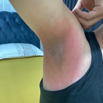 Nivea Men Soft Deodorant Koltuk Altımda Alerji Yaptı