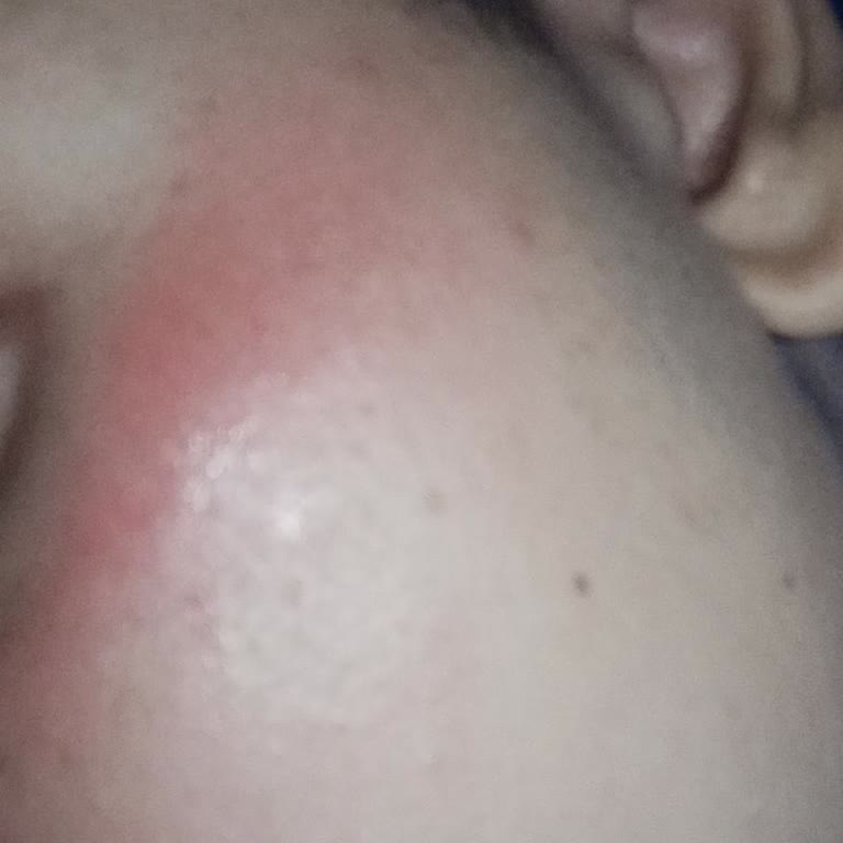 Lure Tüy Dökücü Tahriş, Kızarıklık ve Yanma Meydana Getirdi