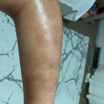 As Clinix Yalova Buz Lazer Yaptırdım Ve İşlem Sonrası Cildimde 1. Derece Yanık Oluştu