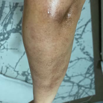 As Clinix Yalova Buz Lazer Yaptırdım Ve İşlem Sonrası Cildimde 1. Derece Yanık Oluştu
