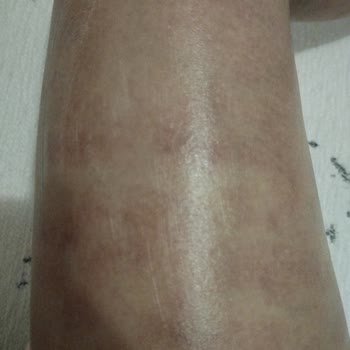 As Clinix Yalova Buz Lazer Yaptırdım Ve İşlem Sonrası Cildimde 1. Derece Yanık Oluştu
