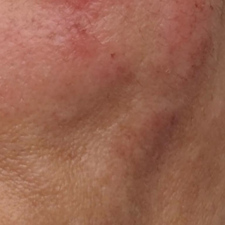 Kullandığım Yüz Kremi Cildimde Yanık Ve Egzamaya Sebep Oldu, Mağduriyetimin Giderilmesini Talep Ediyorum