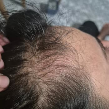 Elidor Şampuanın Yeni Formülü Saç Derimde Sorunlara Yol Açtı