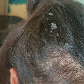 Elidor Şampuanın Yeni Formülü Saç Derimde Sorunlara Yol Açtı