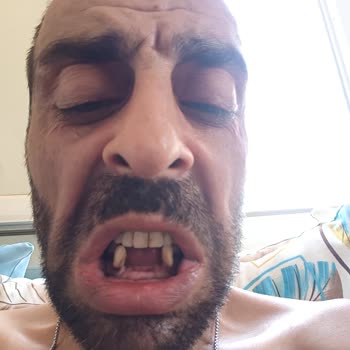 Çekilen Dişlerin Tedavisiz Bırakılması Nedeniyle Mağduriyet Yaşadım