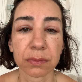 Uzm. Dr. Mustafa Yücel Botoks Sonrası Görme Sorunu Yaşadım