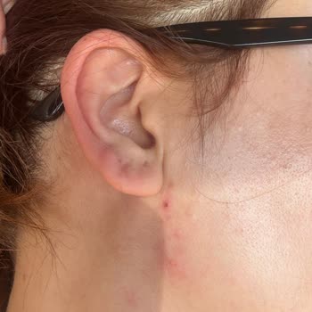 Kozmetik Ürün Kullanımı Sonrası Ciltte Yoğun Sivilce Problemi Ve Mağduriyet