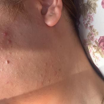 Kozmetik Ürün Kullanımı Sonrası Ciltte Yoğun Sivilce Problemi Ve Mağduriyet