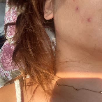 Kozmetik Ürün Kullanımı Sonrası Ciltte Yoğun Sivilce Problemi Ve Mağduriyet