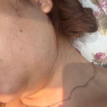 Kozmetik Ürün Kullanımı Sonrası Ciltte Yoğun Sivilce Problemi Ve Mağduriyet