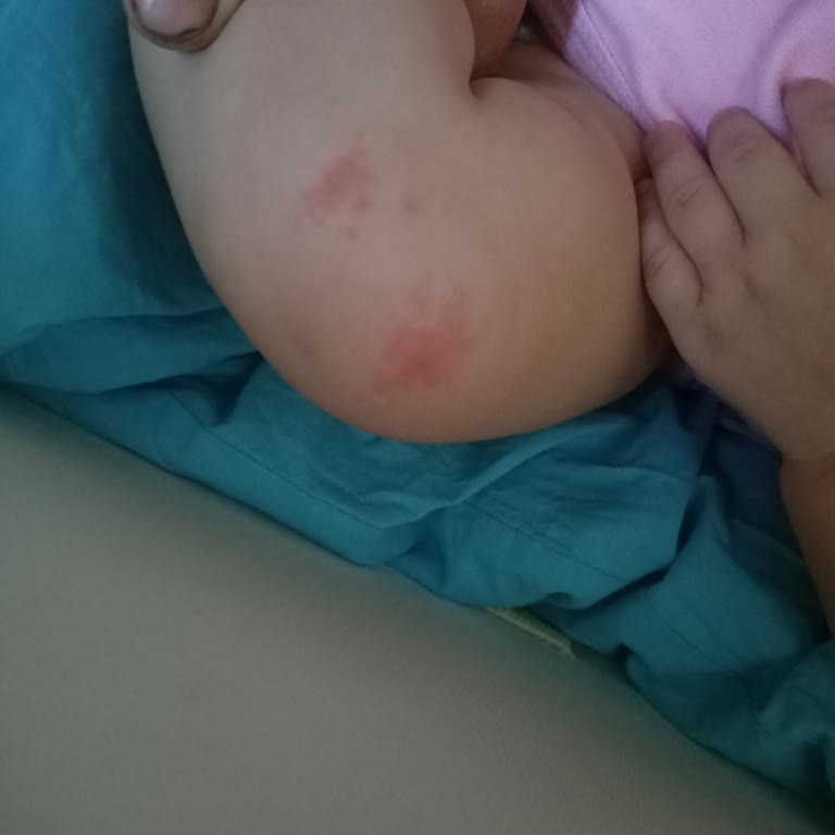 Mama Kullanımı Sonrası Çocuğumda Alerjik Reaksiyon Ve Kusma