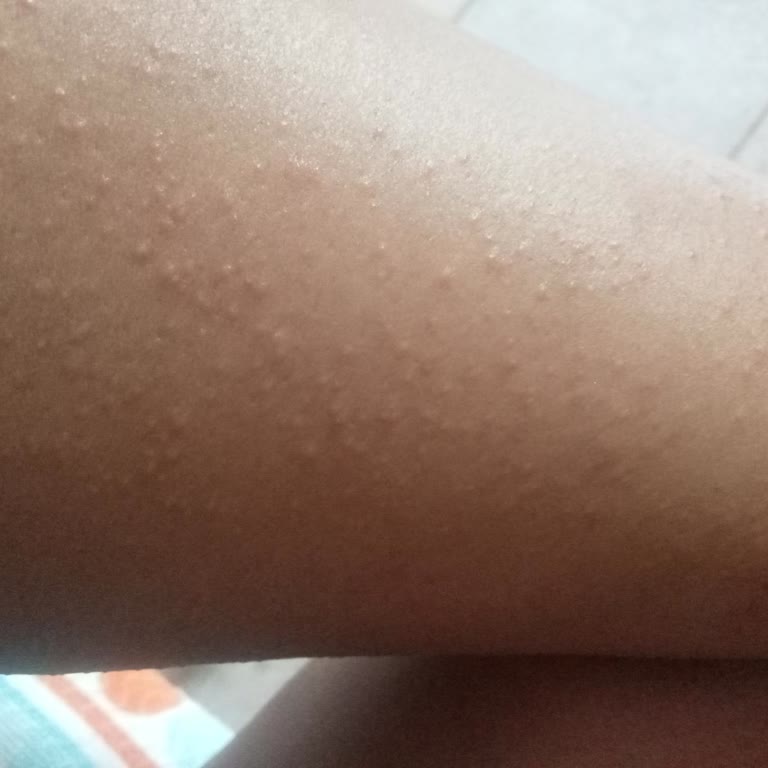 Bronzlaştırıcı Yağ Kullanımı Sonrası Ciddi Alerjik Reaksiyon Ve Mağduriyet