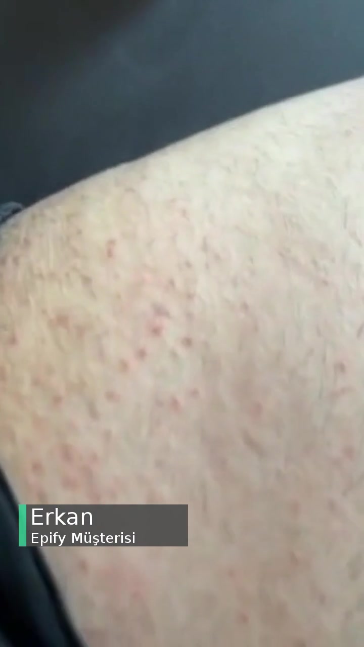 Epify Tüy Dökücü Krem Sonrası Vücudumda Sivilcelenme Oluştu! videonun kapak resmi