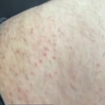 Epify Tüy Dökücü Krem Sonrası Vücudumda Sivilcelenme Oluştu!