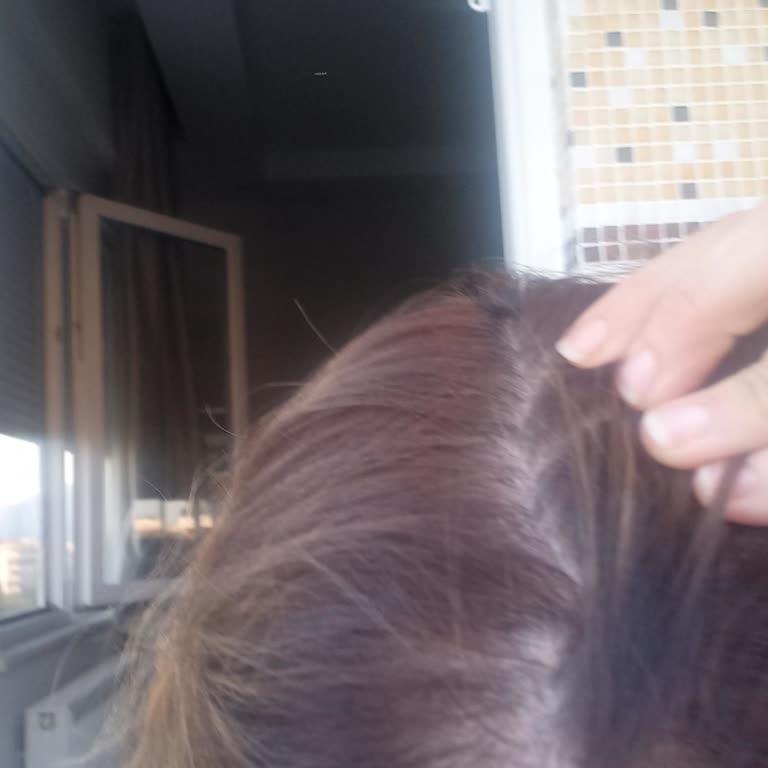 Saç Dökülmesi Tedavisinin Sigorta Kapsamı Dışında Bırakılması Mağduriyet Yarattı