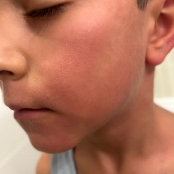 Sivrisinek Sorunu Çocuğumun Sağlığını Tehdit Ediyor, Acil Çözüm Bekliyorum