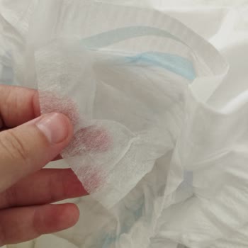 Molfix Bebek Bezlerinde Tela Sorunu Ve Rahatsızlık Yaşanması