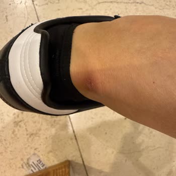 Adidas Samba Ayakkabılar Ayağımı Yaraladı, Mağaza İlgisiz Kaldı