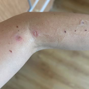 Aslı Geylani Nail Art İşlem Sonrasında Kollarımda Yanıklar Oluştu