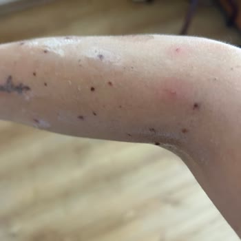 Aslı Geylani Nail Art İşlem Sonrasında Kollarımda Yanıklar Oluştu