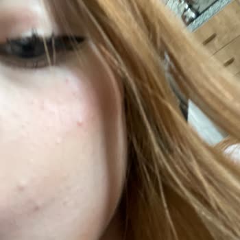 Paden Cosmetics Ürünü Kullandıktan Bir Gün Sonra Cildimde Alerji Ve Kabarcıklar Oluştu