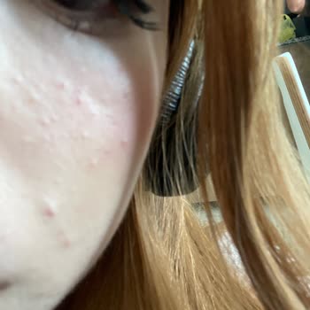 Paden Cosmetics Ürünü Kullandıktan Bir Gün Sonra Cildimde Alerji Ve Kabarcıklar Oluştu